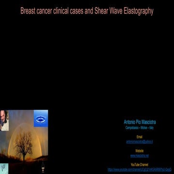 SHEAR WAVE ELASTOGRAPHY of BREAST TUMORS | PPT