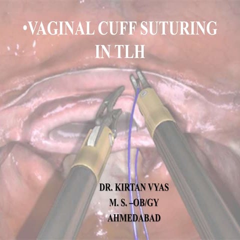Vaginal Vault suturing in TLH 