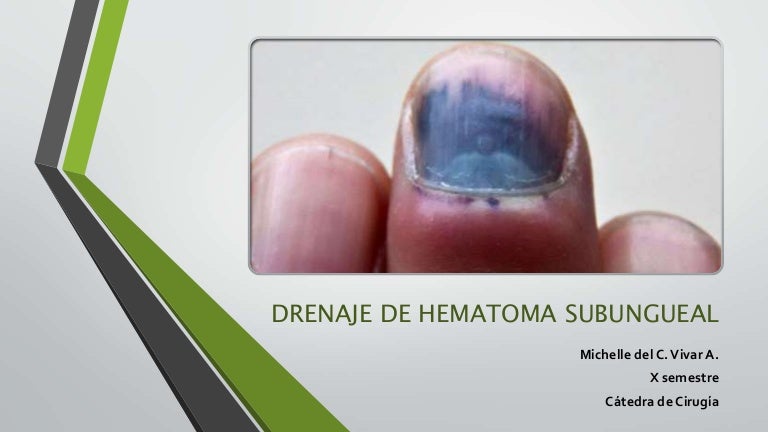 ¿Los tumores duelen como hematomas? ¿Los tumores duelen como hematomas?