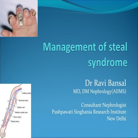 Management of steal syndrome || Dr Ravi Bansal