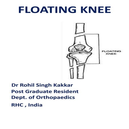 Floating Knee