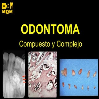 Odontoma