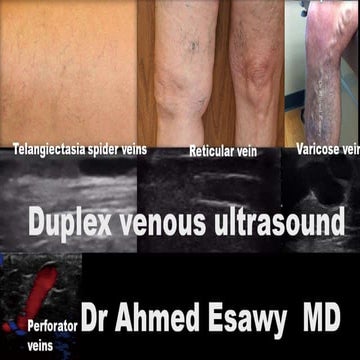 Imaging vastitis differentitis funiculitis seminal vesiculitis Dr Ahmed ...
