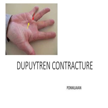 Dupuytren   