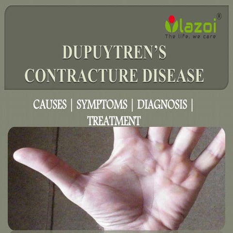 Dupuytren’s Contracture Disease : causes, symptoms and treatment