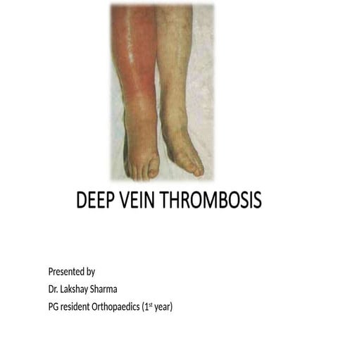 DVT (Deep vein thrombosis) | PDF