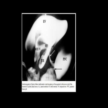 Radiological DW malformation whatsapp.pptx