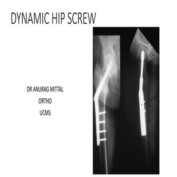 Dynamic hip screw