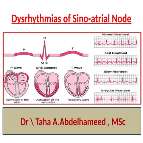 lecture on Dysrhythmias of Sino-atrial Node