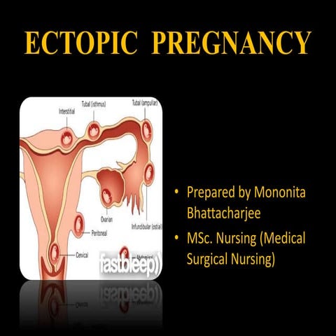 Ectopic Pregnancy
