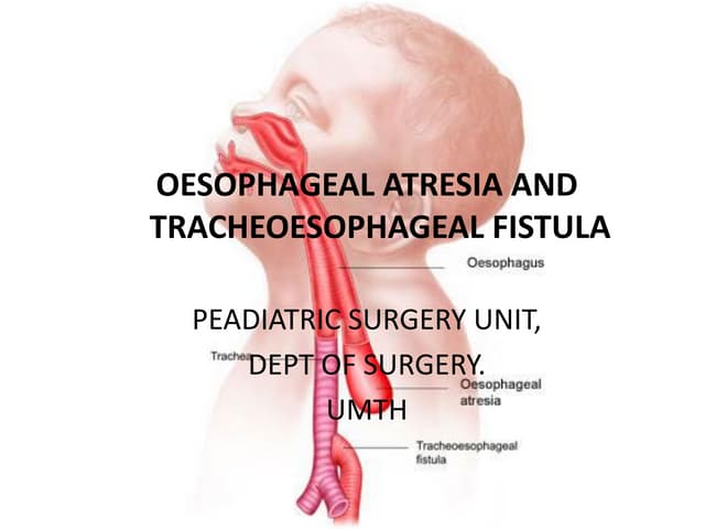 Eosophageal Atresia - Tracheo-esophageal Fistula
