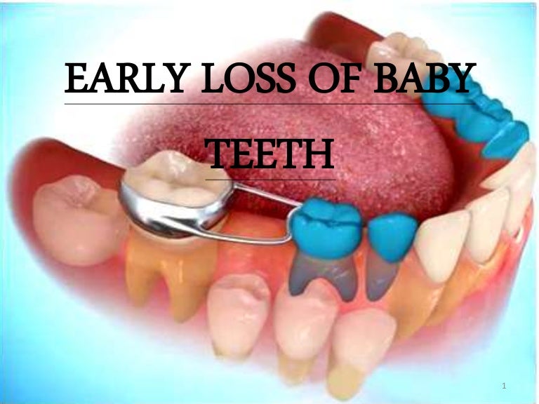 Premature Loss of Baby Teeth Teeth Loss