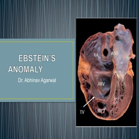 Ebstein Anomaly