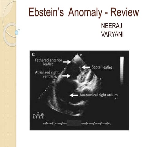 Ebstein anomaly