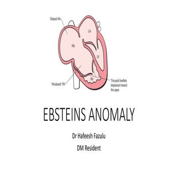 Ebsteins anomaly dr hafeesh fazulu