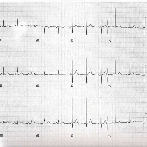 ECG PPI, ASD