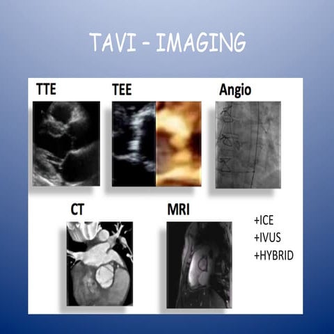 Echocardiography in TAVI patients 2014