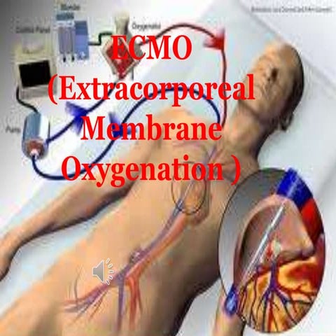 Ecmo