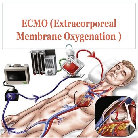 Ecmo