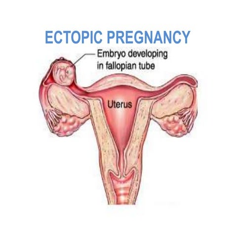 An ectopic pregnancy occurs when a fertilized egg implants and grows outside ...