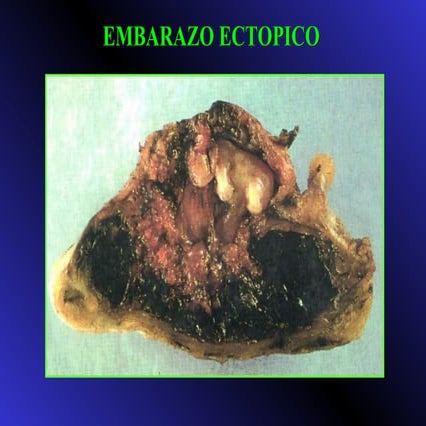 EMBARAZO ECTOPICO TOCOGINECOLOGIA 2025 2026 | PPT