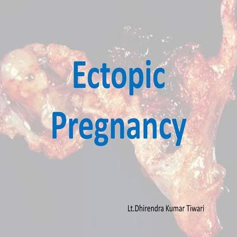 Ectopic pregnancy