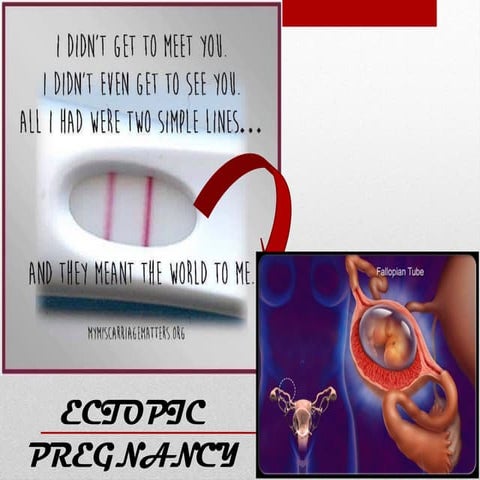 Ectopic pregnancy