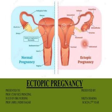 Ectopic pregnancy