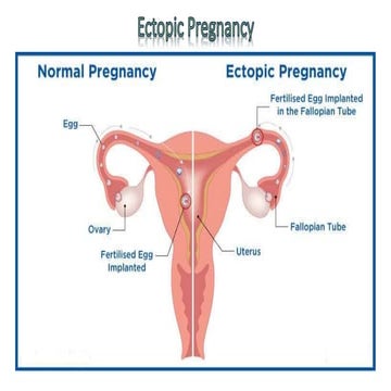 Ectopic pregnancy By Noman Ahmad