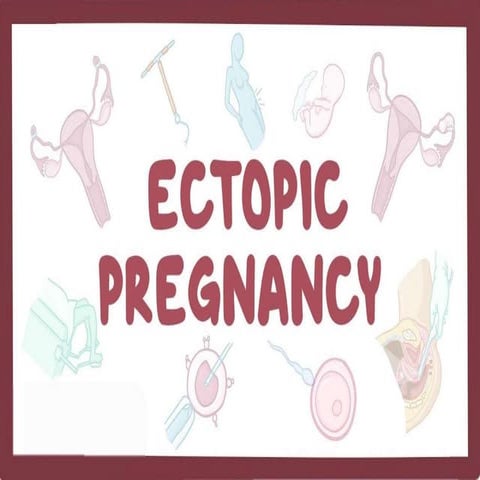 ECTOPIC PREGNANCY