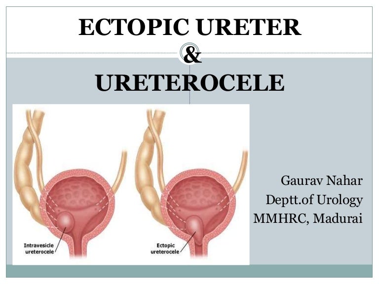 uréter dúplex uréter dúplex