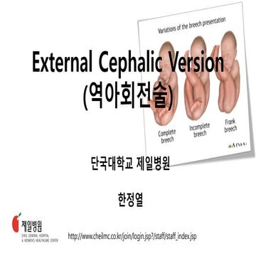 ECV 역아회전술- 한정열 단국대 의대 교수