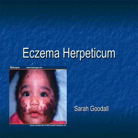Eczema Herpeticum