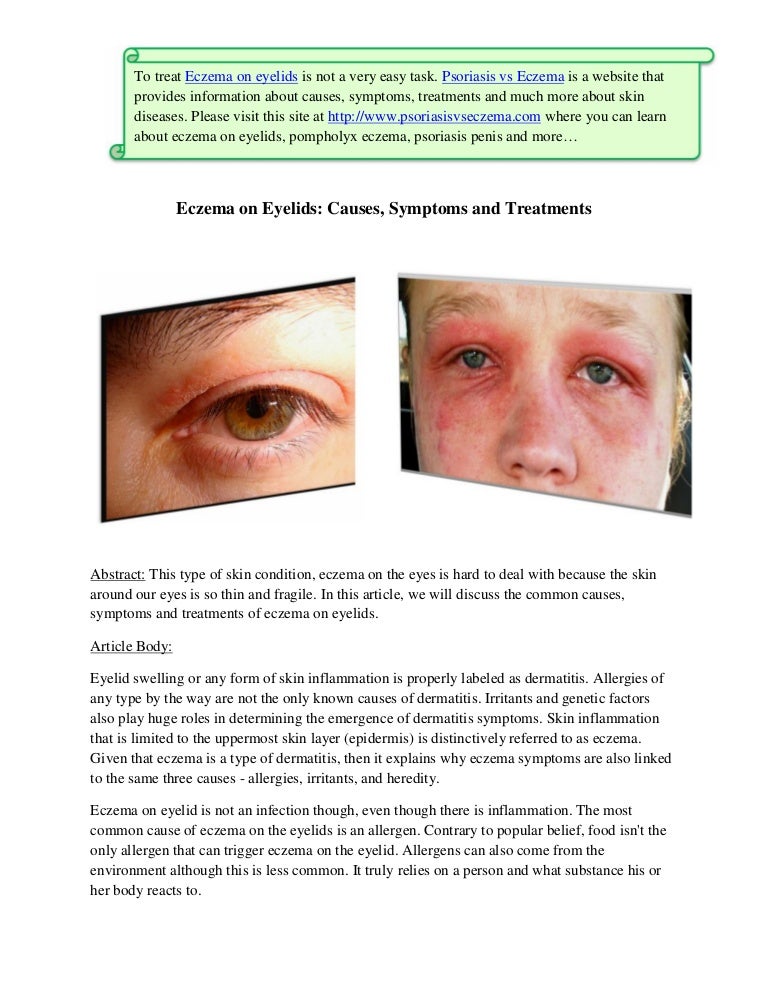 Eczema On Eyelids Causes, Symptoms And Treatments