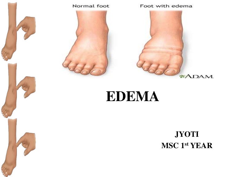 Edema