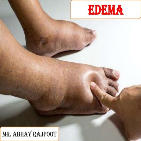 Edema