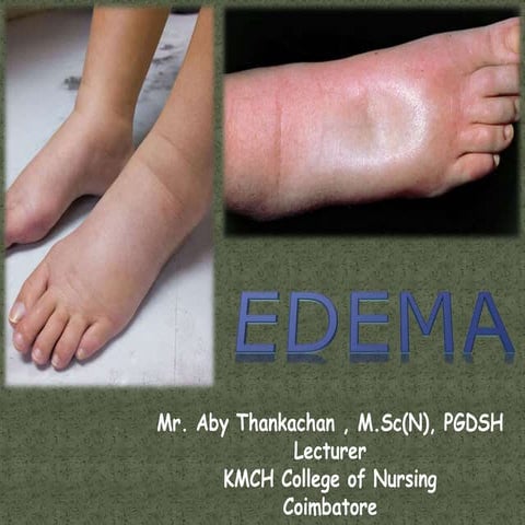 Edema