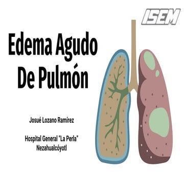 Edema Agudo De Pulmón