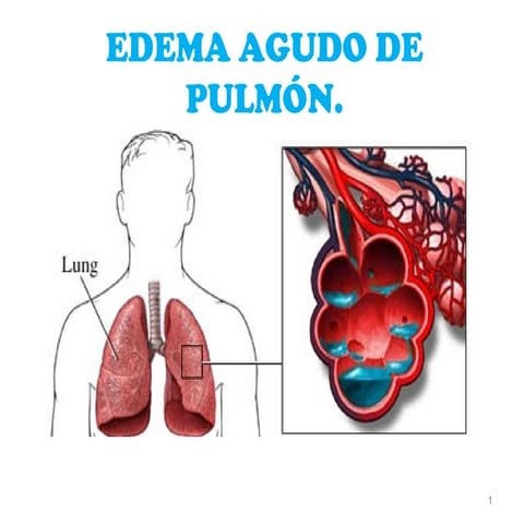 Edema agudo de pulmon 