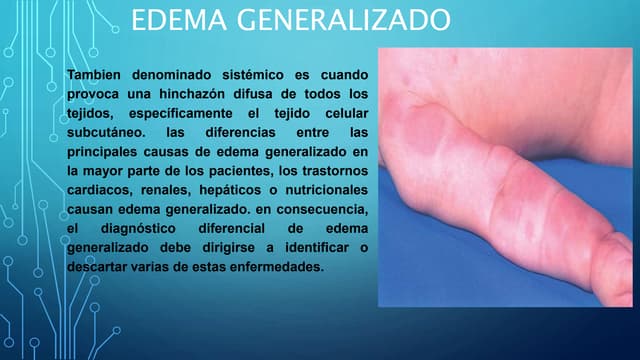 Aquí Que Es Edema General tendencias Aquí Que Es Edema General tendencias