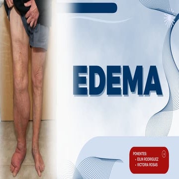 Semiologia: Edema | PPTX