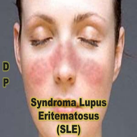 Syndroma Lupus Eritematosus (SLE)