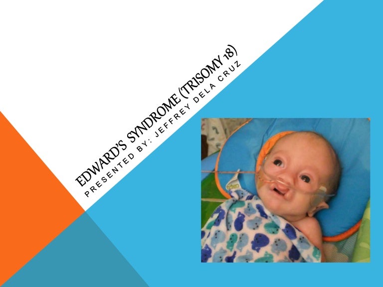 Edward’s syndrome (trisomy 18)