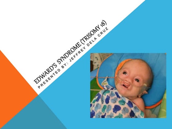 Trisomy 18 | PPT | Pregnancy | Reproductive Health