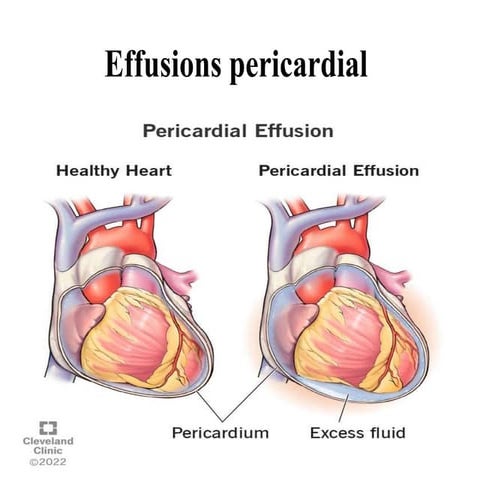 Effusions pericardial.pptx