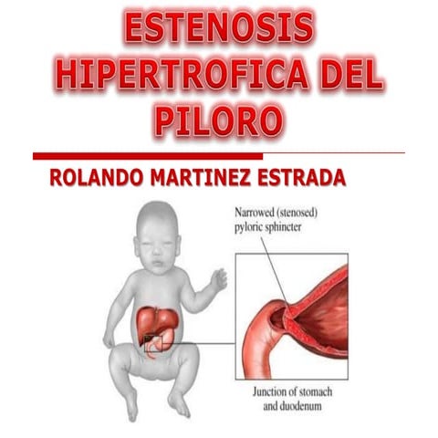 Estenosis Hipertrofica Del Piloro