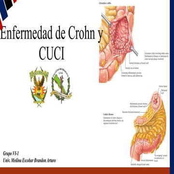 Colitis Ulcerativa | PDF
