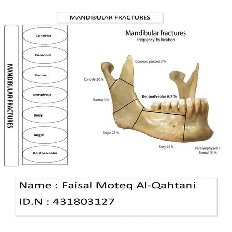 Symphysis & Angle MANDIBULAR FRACTURES 