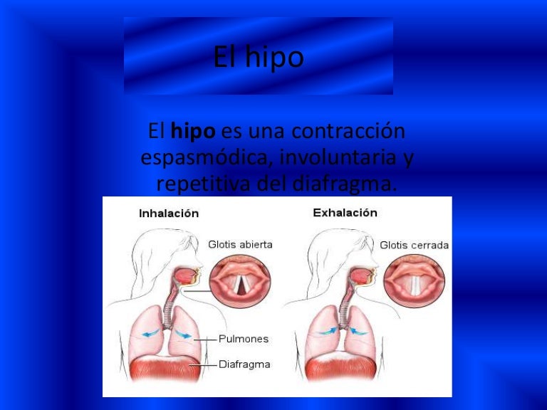 El hipo.