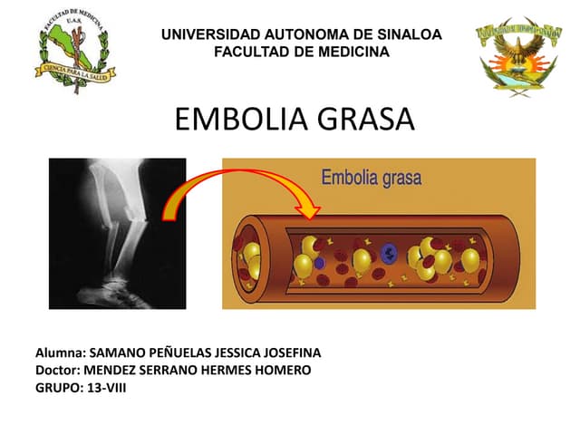 Embolia grasa 